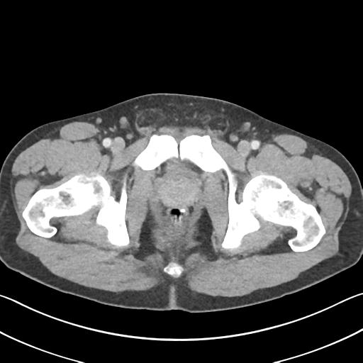 Appendicitis with cecal bar sign (Radiopaedia 31878-32830 B 81).jpg
