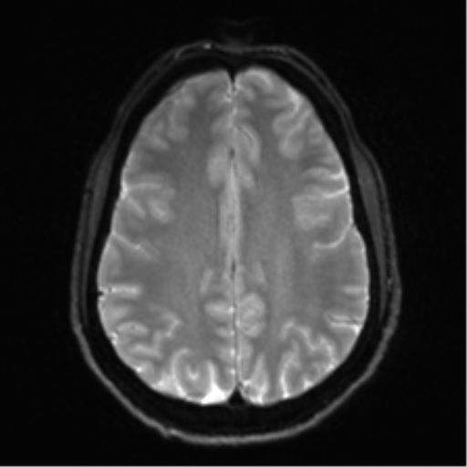 Arachnoid cyst - cerebellopontine angle (Radiopaedia 59689-67083 Axial DWI 25).png