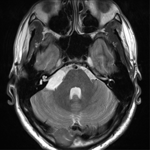 File:Arachnoid cyst - cerebellopontine angle (Radiopaedia 59689-67083 Axial T2 15).png