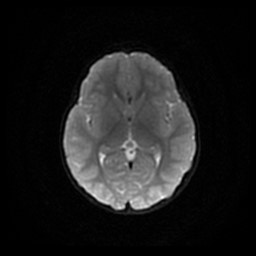 File:Arachnoid cyst - middle cranial fossa (Radiopaedia 86780-102938 Axial DWI 44).jpg