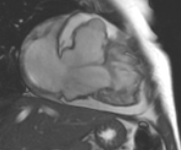 Arrhythmogenic right ventricular cardiomyopathy (Radiopaedia 69431-79307 2ch cine 49).jpg