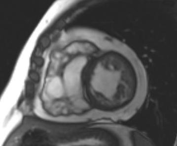 File:Arrhythmogenic right ventricular cardiomyopathy (Radiopaedia 69431-79307 Short axis cine 103).jpg