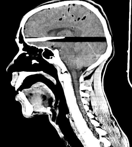Arrow injury to the brain (Radiopaedia 72101-82607 H 32).jpg
