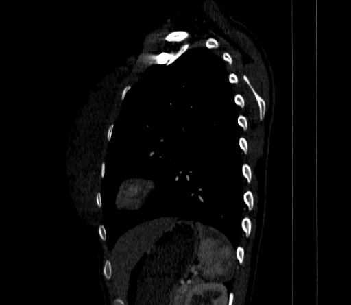 File:Arteria lusoria (Radiopaedia 88528-105192 C 70).jpg