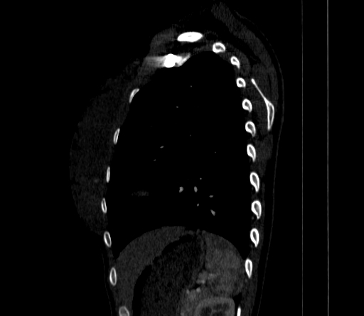 Arteria lusoria (Radiopaedia 88528-105192 C 71).jpg