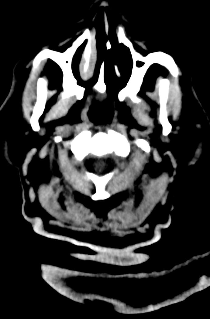 Artery of Percheron infarction (Radiopaedia 80613-94202 Axial non-contrast 1).jpg