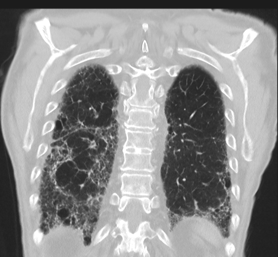 Asbestosis (Radiopaedia 56192-62864 Coronal lung window 42).png