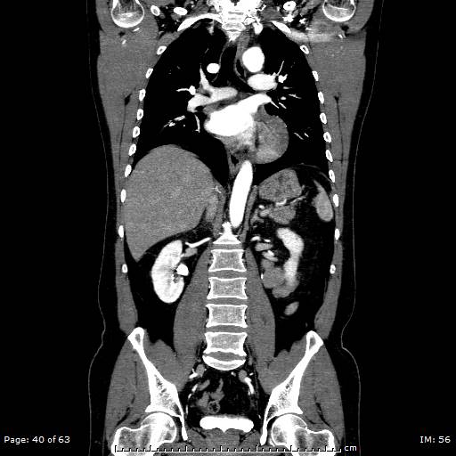 Ascending aortic aneurysm (Radiopaedia 50086-55404 B 40).jpg