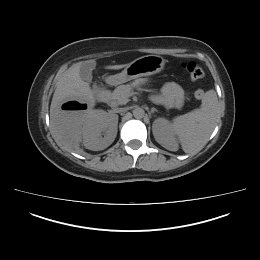 Ascending retrocecal appendicitis with liver abscesses (Radiopaedia 60066-67615 Axial non-contrast 29).jpg