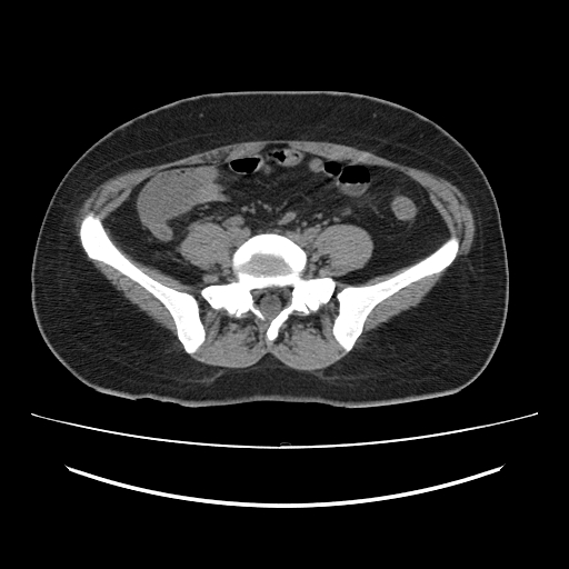 File:Ascending retrocecal appendicitis with liver abscesses (Radiopaedia 60066-67615 Axial non-contrast 59).jpg