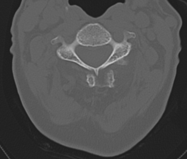 Atlanto-axial subluxation (Radiopaedia 36610-38176 Axial bone window 25).png