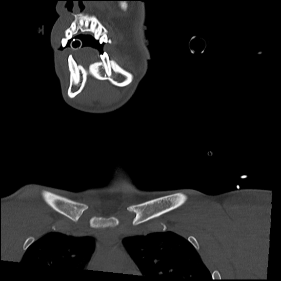 Atlanto-occipital dissociation (Traynelis type 1), C2 teardrop fracture, C6-7 facet joint dislocation (Radiopaedia 87655-104061 Coronal bone window 8).jpg