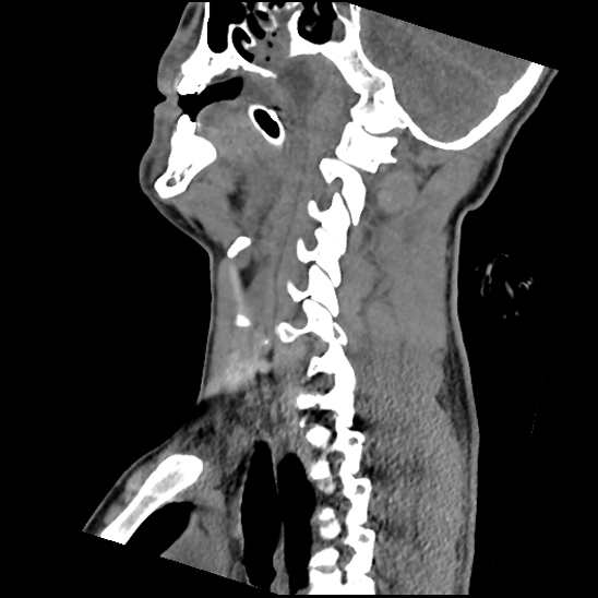 Atlanto-occipital dissociation (Traynelis type 1), C2 teardrop fracture, C6-7 facet joint dislocation (Radiopaedia 87655-104061 D 37).jpg