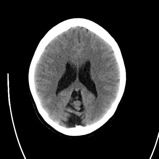 File:Atretic encephalocoele with inferior vermis hypoplasia (Radiopaedia 30443-31107 A 16).jpg