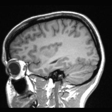 Atretic encephalocoele with inferior vermis hypoplasia (Radiopaedia 30443-31108 Sagittal T1 98).jpg