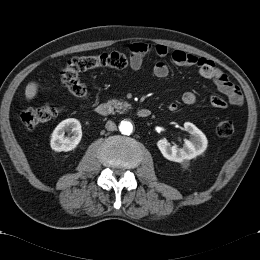 Atypical hepatocellular carcinoma (Radiopaedia 41744-44698 A 54).jpg