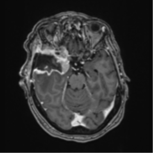 Atypical meningioma (WHO Grade II) (Radiopaedia 54742-60981 Axial T1 C+ 25).png