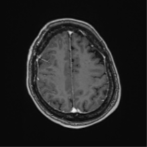 Atypical meningioma (WHO Grade II) (Radiopaedia 54742-60981 Axial T1 C+ 55).png