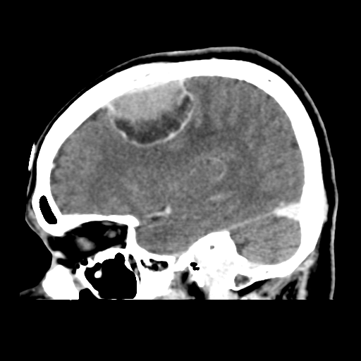 Atypical meningioma (WHO grade II) with osseous invasion (Radiopaedia 53654-59715 G 17).png