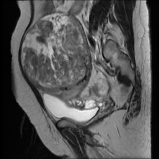 File:Atypical retroperitoneal lymphocoeles with large leiomyoma of uterus (Radiopaedia 32084-33027 Sagittal T2 21).jpg