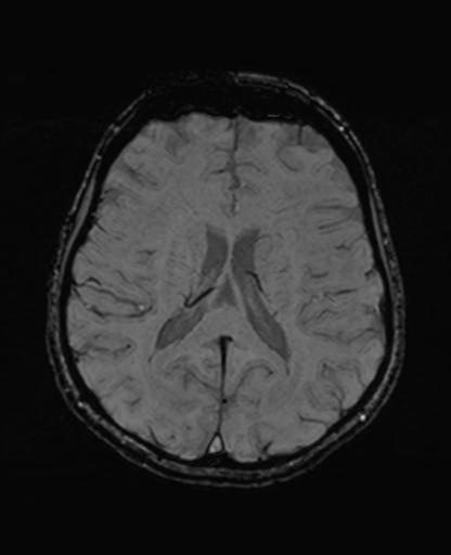 Autoimmune limbic encephalitis (Radiopaedia 30363-31005 SWI 47).jpg