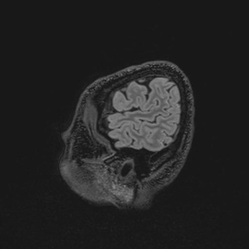 Autoimmune limbic encephalitis (Radiopaedia 30363-31005 Sagittal FLAIR 136).jpg