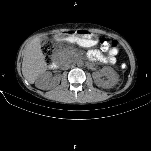 Autoimmune pancreatitis (Radiopaedia 84925-100431 Axial non-contrast 24).jpg