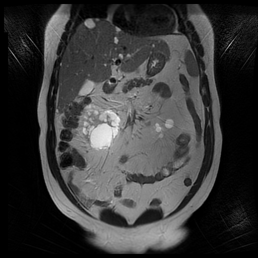 File:Autosomal dominant polycystic kidney disease (Radiopaedia 50259-55611 Coronal T2 14).jpg