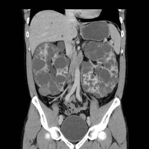 Autosomal dominant polycystic kidney disease (Radiopaedia 66349-75582 A 37).jpg