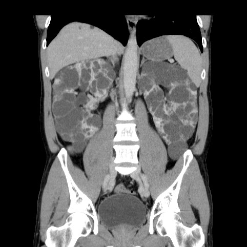 Autosomal dominant polycystic kidney disease (Radiopaedia 66349-75582 A 49).jpg