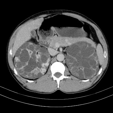 Autosomal dominant polycystic kidney disease (Radiopaedia 66349-75582 B 31).jpg
