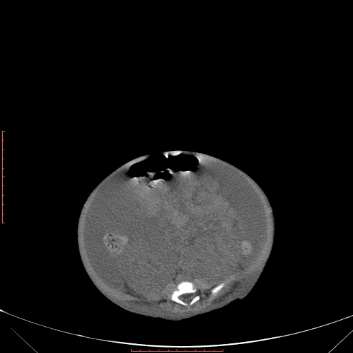 Autosomal recessive polycystic kidney disease associated with Caroli disease (Radiopaedia 61932-69984 B 258).jpg
