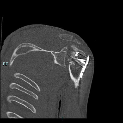 Avascular necrosis after fracture dislocations of the proximal humerus (Radiopaedia 88078-104655 Coronal bone window 79).jpg