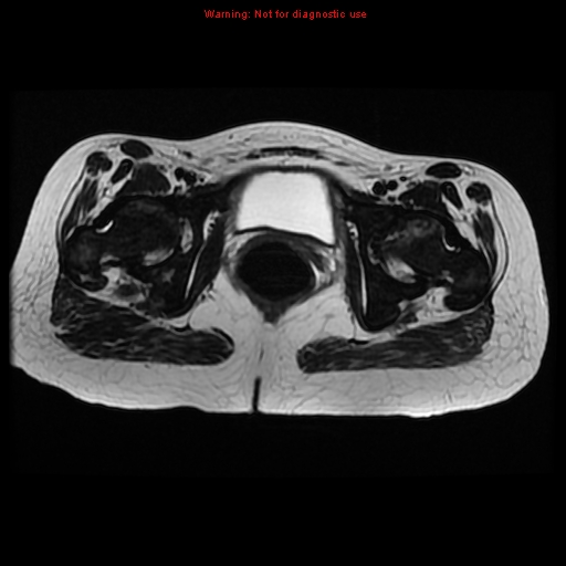 File:Avascular necrosis in sickle cell disease (Radiopaedia 17448-17151 Axial T2 10).jpg