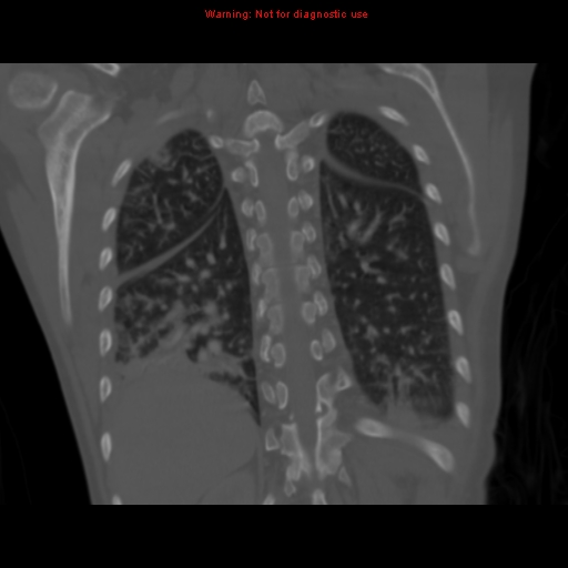 Avascular necrosis in sickle cell disease (Radiopaedia 17448-17152 Coronal bone window 98).jpg