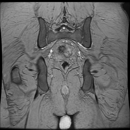 Avascular necrosis of the hip (Radiopaedia 61503-69465 F 82).jpg
