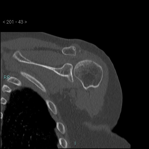 Avascular necrosis of the shoulder - Cruess stage I (Radiopaedia 77674-89887 Coronal bone window 42).jpg