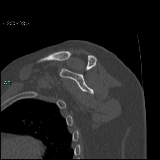 Avascular necrosis of the shoulder - Cruess stage I (Radiopaedia 77674-89887 Sagittal bone window 27).jpg