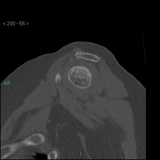 File:Avascular necrosis of the shoulder - Cruess stage I (Radiopaedia 77674-89887 Sagittal bone window 55).jpg