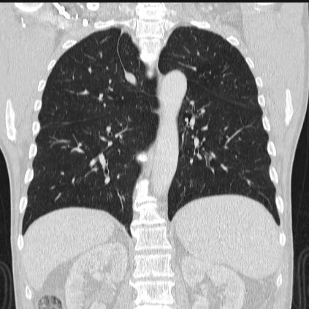 Azygos lobe (Radiopaedia 38259-40275 Coronal lung window 53).jpg