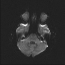 Balo concentric sclerosis (Radiopaedia 50458-55940 Axial DWI 40).jpg