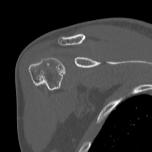 Bankart lesion (Radiopaedia 57256-64185 Coronal bone window 18).jpg