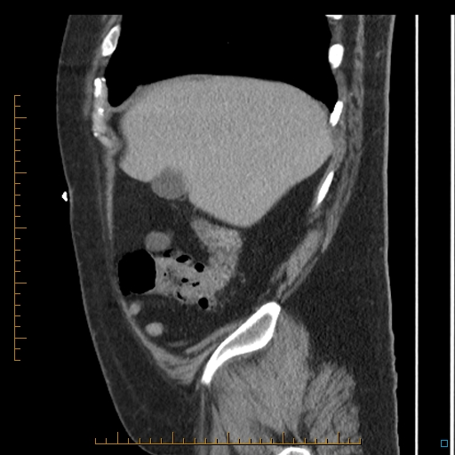 File:Bariatric balloon causing gastric outlet obstruction (Radiopaedia 54449-60672 C 68).jpg