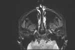 File:Basal cell carcinoma - nasal region (Radiopaedia 70292-80365 Axial DWI 15).jpg