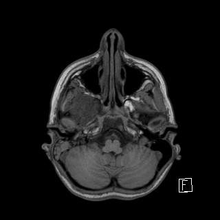 Base of skull rhabdomyosarcoma (Radiopaedia 32196-33142 Axial T1 9).jpg