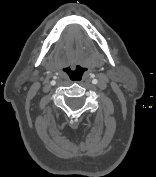 Basilar artery aneurysm (Radiopaedia 56261-62932 A 11).jpg