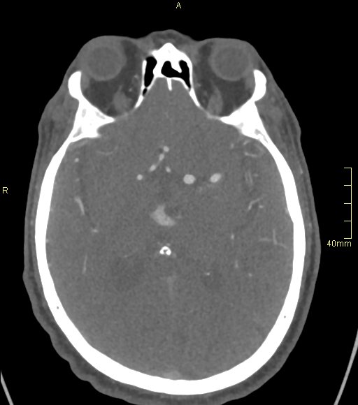 Basilar artery aneurysm (Radiopaedia 56261-62932 A 81).jpg