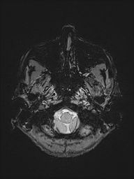 Basilar artery perforator aneurysm (Radiopaedia 82455-97733 Axial SWI 2).jpg