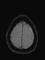 Basilar artery perforator aneurysm (Radiopaedia 82455-97733 Axial SWI 54).jpg