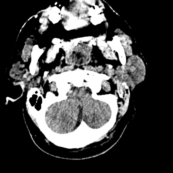 Basilar artery thrombosis (Radiopaedia 53351-59333 Axial non-contrast 20).jpg
